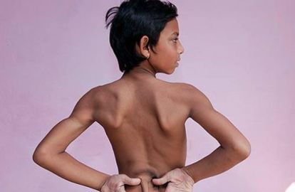 ინდოეთში კუდიანი ბიჭი ღვთაებად გამოაცხადეს