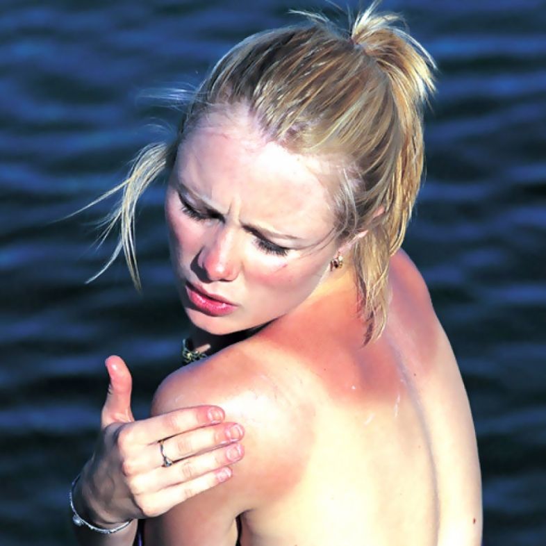 სახლში მომზადებული სასწაულმოქმედი 6 ლოსიონი დამწვრობის სამკურნალოდ