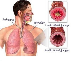 უებარი საშუალება სასუნთქი გზების და ბრონქიტის სამკურნალოდ