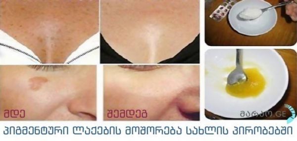 სუპერმეთოდი!! პიგმენტური ლაქების მოცილება სახლის პირობებში. შედეგი გაგაოცებთ!