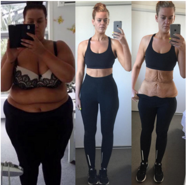 ქალმა, რომელმაც 85 კილო დაიკლო, ინტერნეტმომხმარებლების აგრესია გამოიწვია: როგორ დაამტკიცა მან საკუთარი სიმართლე