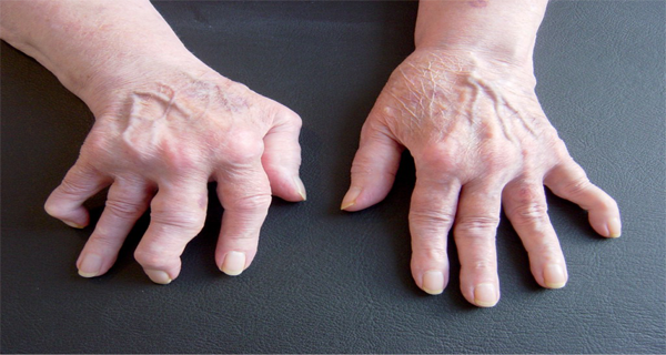 რევმატიზმი - უმკურნალეთ ხელებს საკუთარი ხელებით